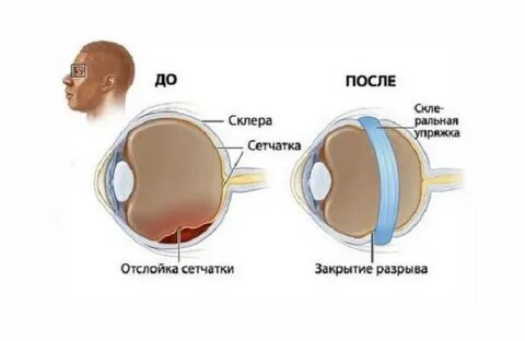 Отслойка сетчатки глаза операция