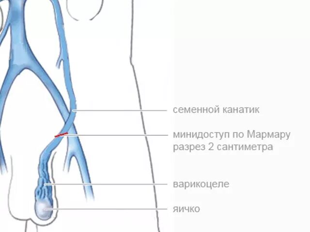 Расширение вены семенного канатика. Операция варикоцеле по Мармару. Варикоцеле по Мармару ход операции. Операция на варикоцеле по методу Мармара. Операция при варикоцеле (операция Мармара).