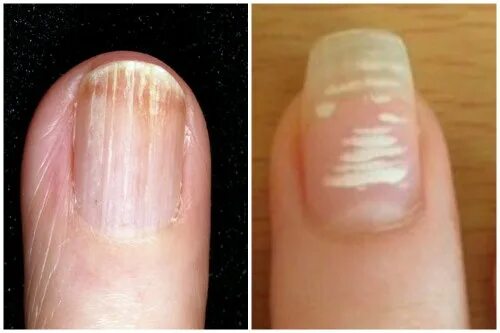 Полоски на ногтях причины вертикальные у женщин. Поперечные полоски на ногтях. Продольные полосы на ногтях. Продольные белые полоски на ногтях. Поперечные белые полоски на ногтях.