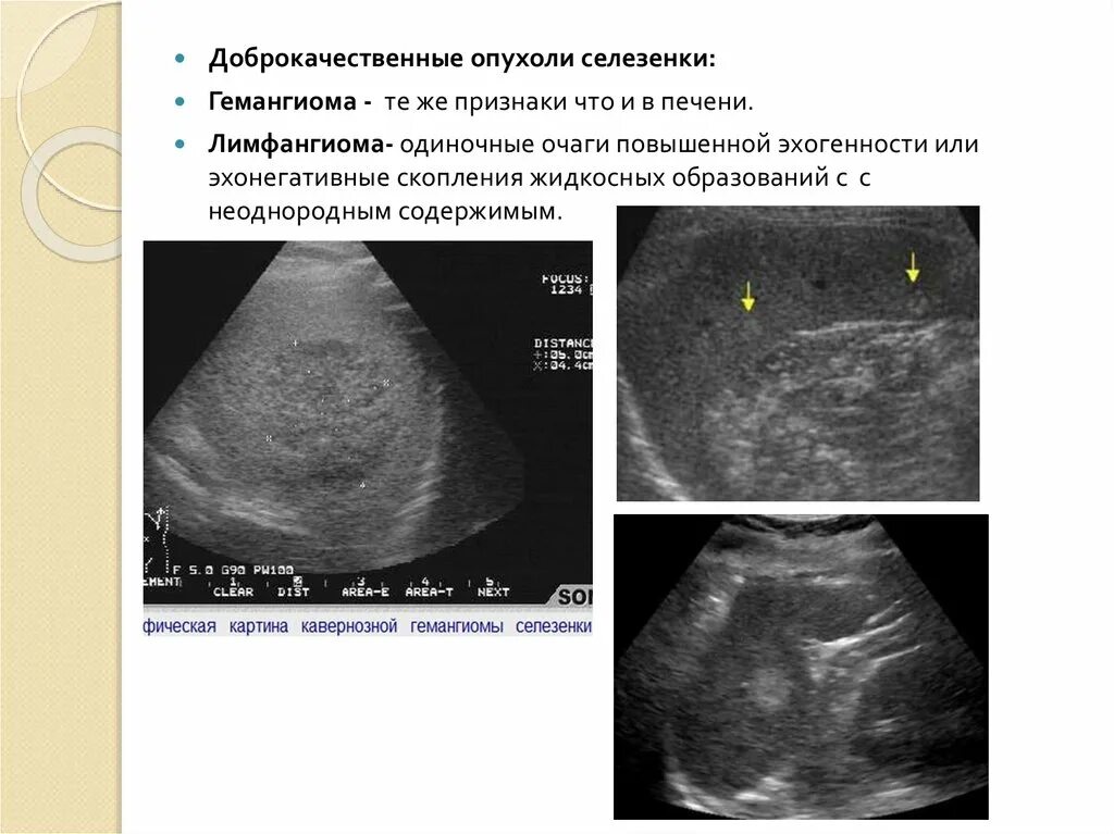 Лимфома селезенки УЗИ картина. Новообразования селезенки.