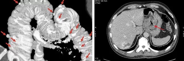 Дивертикулит кишечника мрт. Кт брюшной полости опухоль желудка. На кт видно опухоль