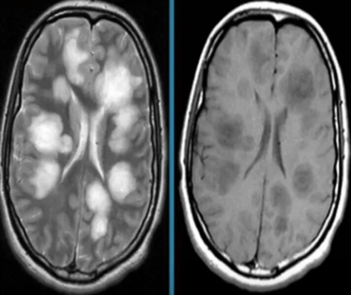 Мелкие очаги в головном мозге. Очаги глиоза в головном мозге мрт. Острый рассеянный энцефаломиелит кт. Супратенториальный глиоз. Острый энцефаломиелит мрт.