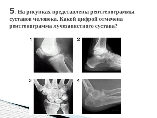 Какой сустав изображен. Рентгенограмма лучезапястного сустава протокол рентген. Рентгенография суставов. Сравнительный рентгенограммы лучезапястных суставов. Шаблон описания рентгенограмм суставов.