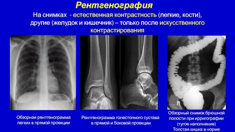 Почему кости легкие. Контрастность рентгенограммы. Контрастность снимка рентген. Рентгенография брюшной. Контрастирование легких рентген.