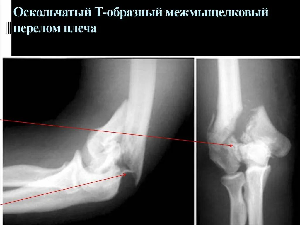 Внутрисуставной чрезмыщелковый перелом плечевой кости. Мыщелковый перелом плечевой кости. Перелом дистального отдела плечевой кости рентген. Т образный перелом мыщелка плечевой кости.