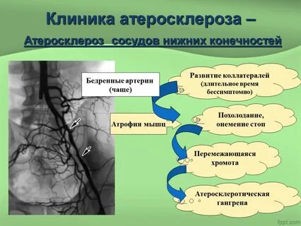 Что такое нестенозирующий атеросклероз артерий нижних конечностей