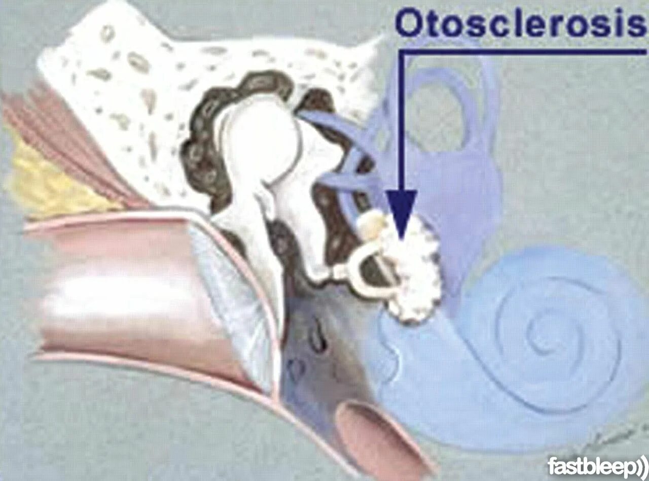 Отосклероз уха операция. Кохлеарная форма отосклероза. Отосклероз гистология. Тимпанальный отосклероз. Кондуктивный отосклероз.
