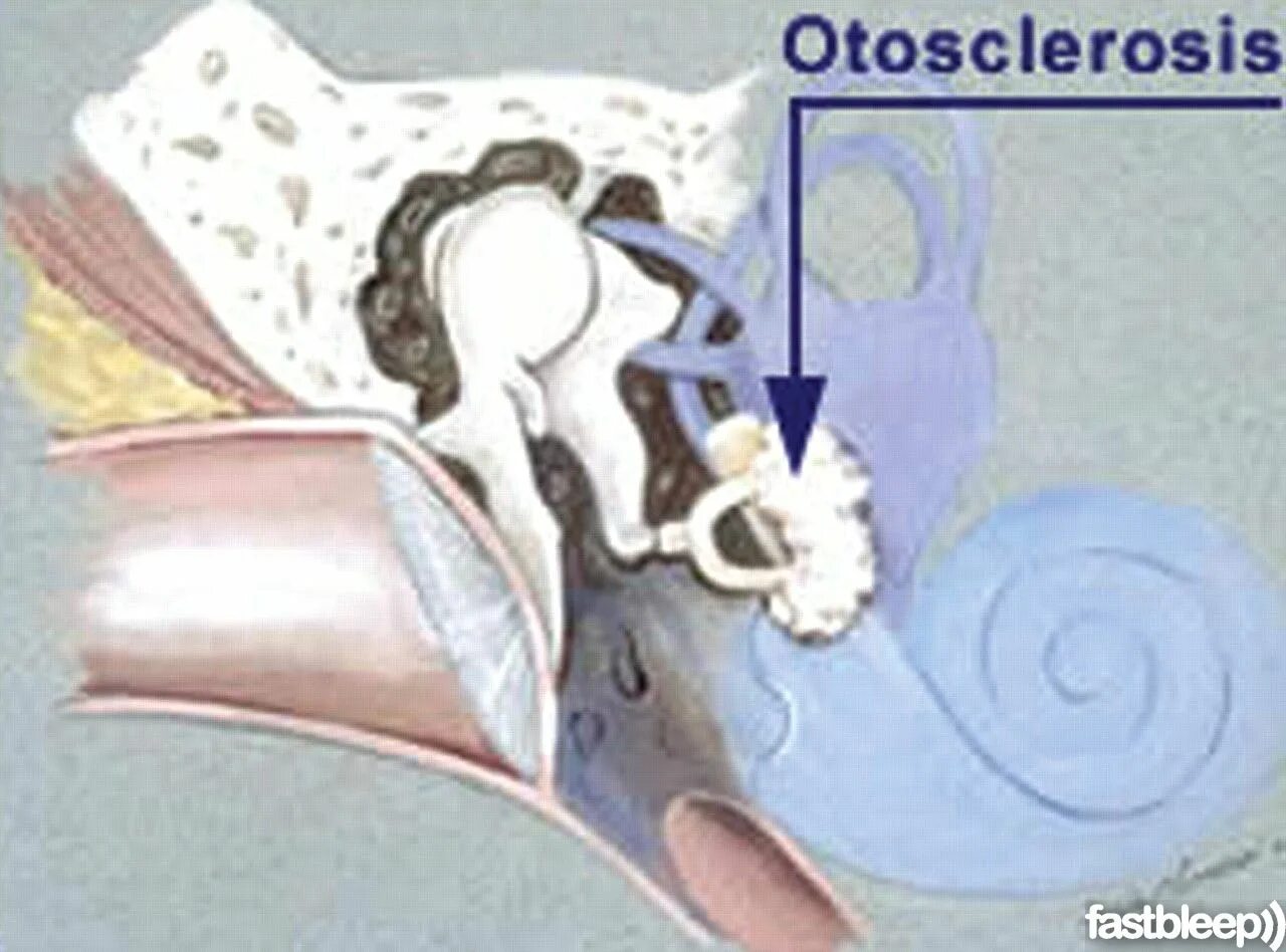 Кохлеарная форма отосклероза. Отосклероз гистология. Тимпанальный отосклероз. Кондуктивный отосклероз. Отосклероз уха операция