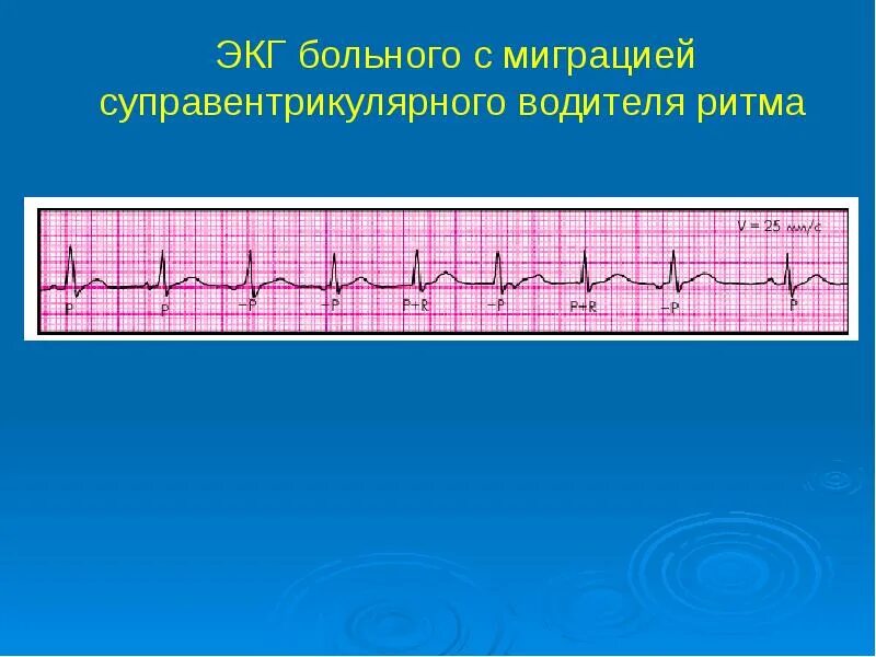 Миграция предсердного водителя ритма на экг. Миграция суправентрикулярного водителя ритма на экг. Экг при миграции водителя ритма. Суправентрикулярный водитель ритма миграция. Миграция наджелудочкового водителя.