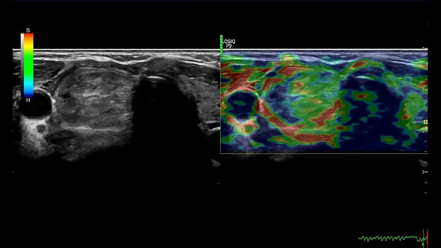 Ультразвуковая компрессионная эластография. Ультразвуковая эластография печени сдвиговой волной. УЗИ щитовидной эластография. Компрессионная эластография щитовидной железы.