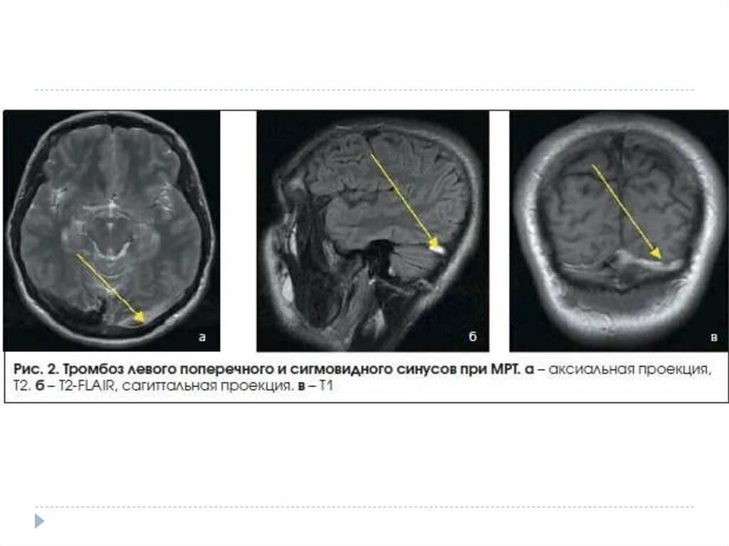 Тромбоз поперечного венозного синуса на мрт. Тромбоз сагиттального синуса на кт. Тромбоз венозного синуса головного мозга кт. Тромбоз венозного синуса головного мозга мрт. Тромбоз на кт