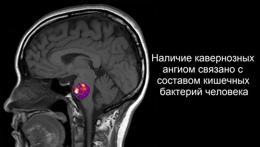 Ангиома головного мозга кт. Кавернозная ангиома мрт. Кавернозная ангиома левой лобной доли. Кавернозная ангиома мозжечка. Ангиома правой лобной