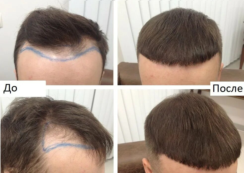 Стрижка после пересадки волос. Линия волос у мужчин. Пересадка волос на голове.