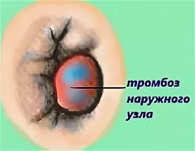Тромбоз в родах