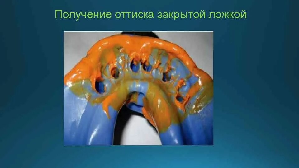 Оттиска индивидуальной ложкой. Снятие оттиска закрытой ложкой. снятие оттиска методом закрытой ложки. ложки для получения оттисков. техника получения оттисков.