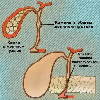 Симптом курвуазье