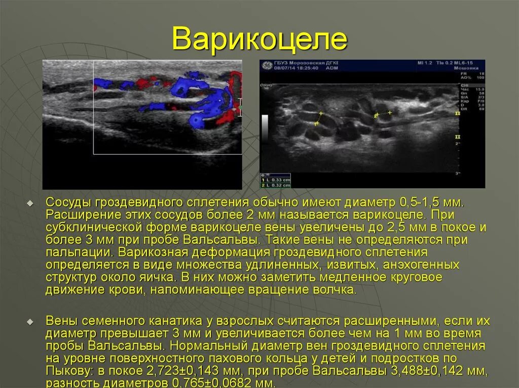 Вены семенного канатика норма УЗИ. Варикозное расширение вен семенного канатика на УЗИ. Классификация варикоцеле по УЗИ. Степени варикоцеле по УЗИ. Артерии яичка