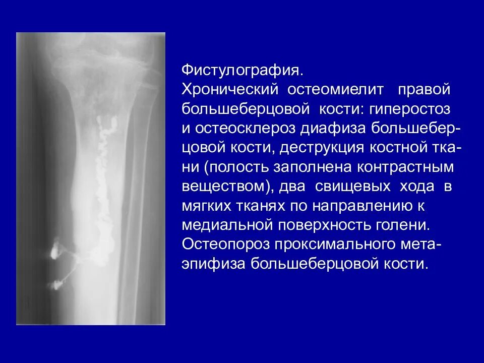 Остеосклероз костной ткани. Хронический остеомиелит большеберцовой кости рентген. фистулография остеомиелит. хронический остеомиелит большеберцовой кости кт. хронический остеомиелит остеосклероз.