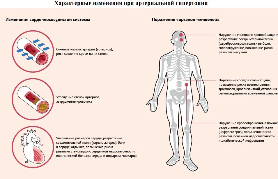 Как понять что у тебя давление симптомы. Гипертоническая болезнь характерные признаки. симптомы артериальной гипертензии гипертонической болезни. для гипертонической болезни характерны симптомы. органы-мишени при артериальной гипертензии.