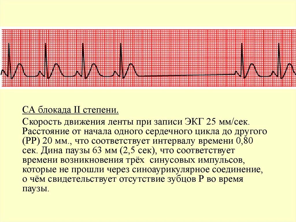 Са блокада 1 степени. Синоатриальная блокада Мобитц 1 ЭКГ. Са блокада 2 степени Мобитц 1 на ЭКГ. АВ блокада 2 ст Мобитц 2 ЭКГ. Синоатриальная блокада 2 степени Мобитц 1.