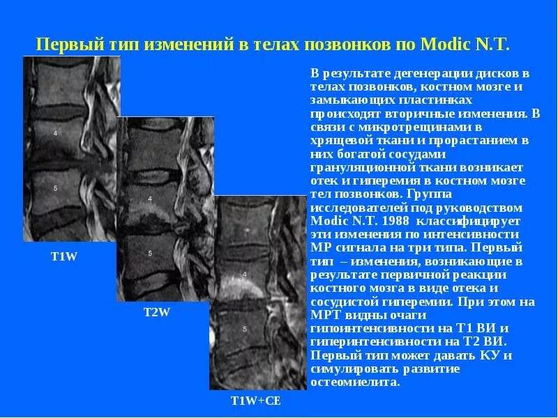 Отёк костного мозга тел позвонков l4-5. Отек костного мозга позвонок s5. Отек тел позвонков на мрт. Изменения позвонков по типу модик.