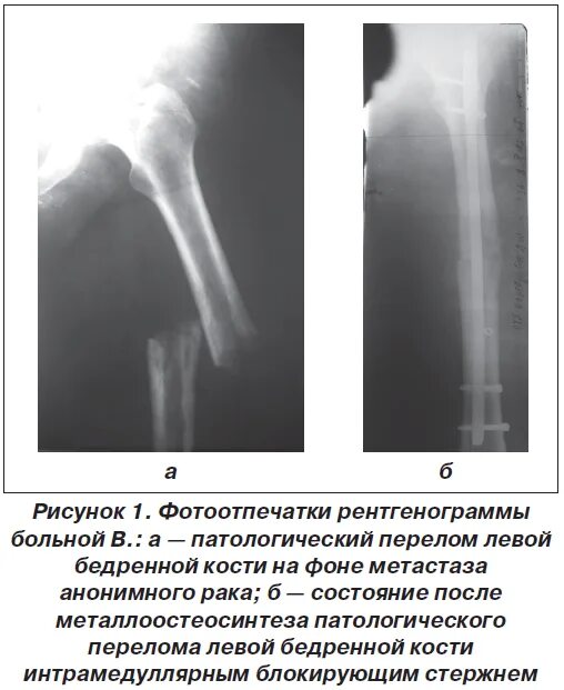 Метастаз в кости мрт - 16/48