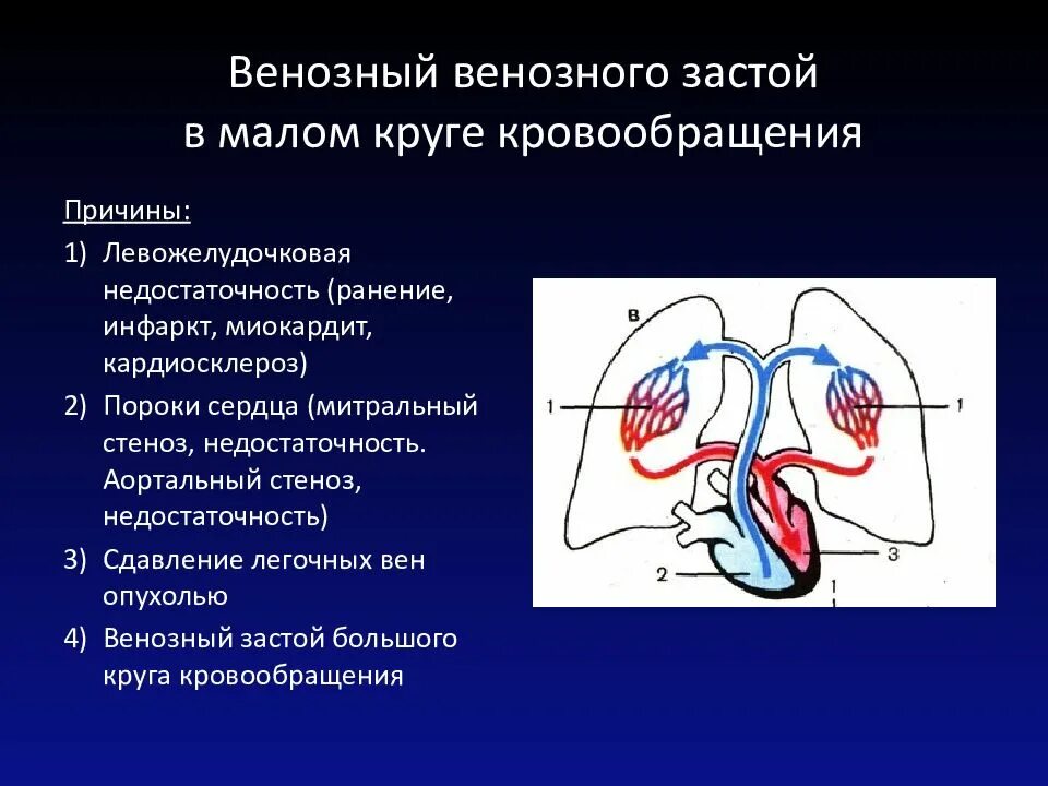 Нарушение кровообращения малого круга. Застой в Малом круге кровообращения. Застой в Малом кургу кровообращения. Застой в Малом круге кровообращения причины. Симптомы малого круга кровообращения.