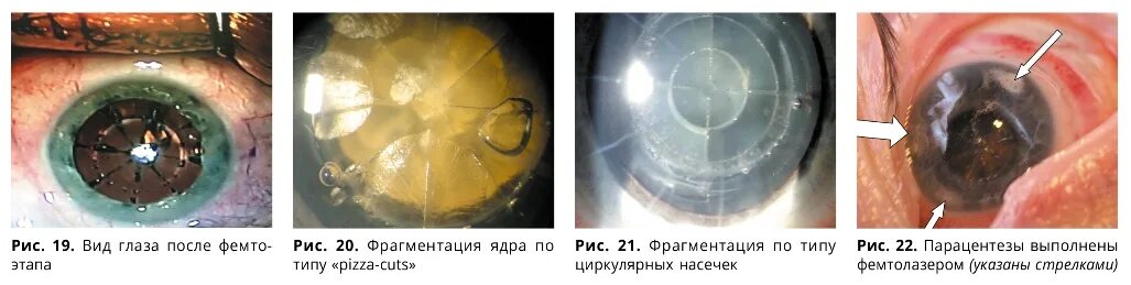 Замена хрусталика когда можно в баню. Рекомендации после операции катаракты хрусталика. Памятка после операции по замене хрусталика глаза. Замутнение хрусталика. Катаракта факоэмульсификация.