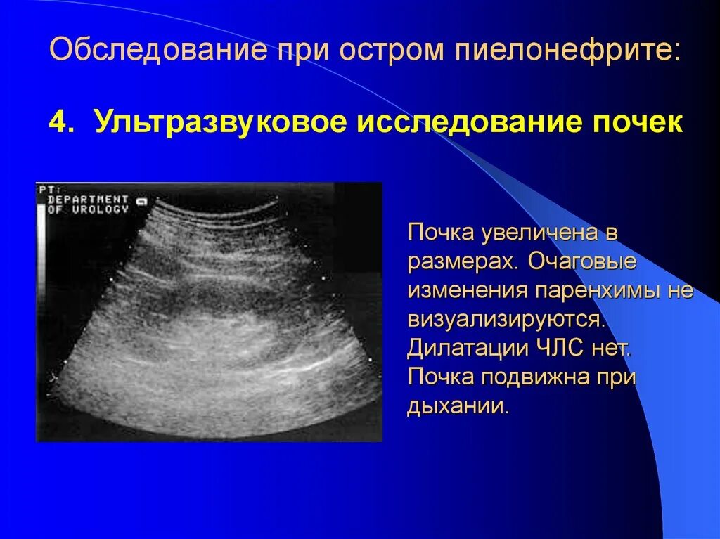 Хронический пиелонефрит УЗИ. Острый пиелонефрит УЗИ. УЗИ критерии хронического пиелонефрита. УЗИ почек острый пиелонефрит. Узи почка не видна