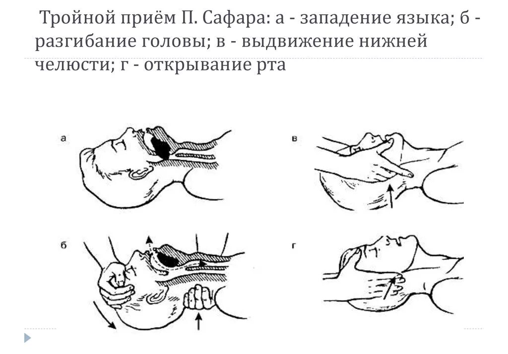 Тройной прием алгоритм. Приемы восстановления проходимости дыхательных путей.