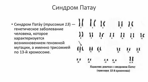 Кариотип больного с синдромом патау