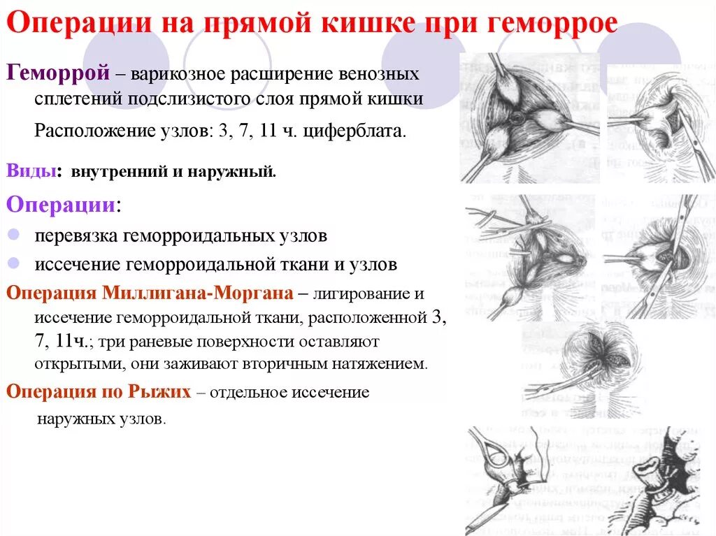 Какие операции делают прямой кишки. Операция миллигана моргана. этапы операции миллигана моргана. схема операции геморроидэктомия по методу мельгано- моргана. геморроидэктомия миллигана моргана.