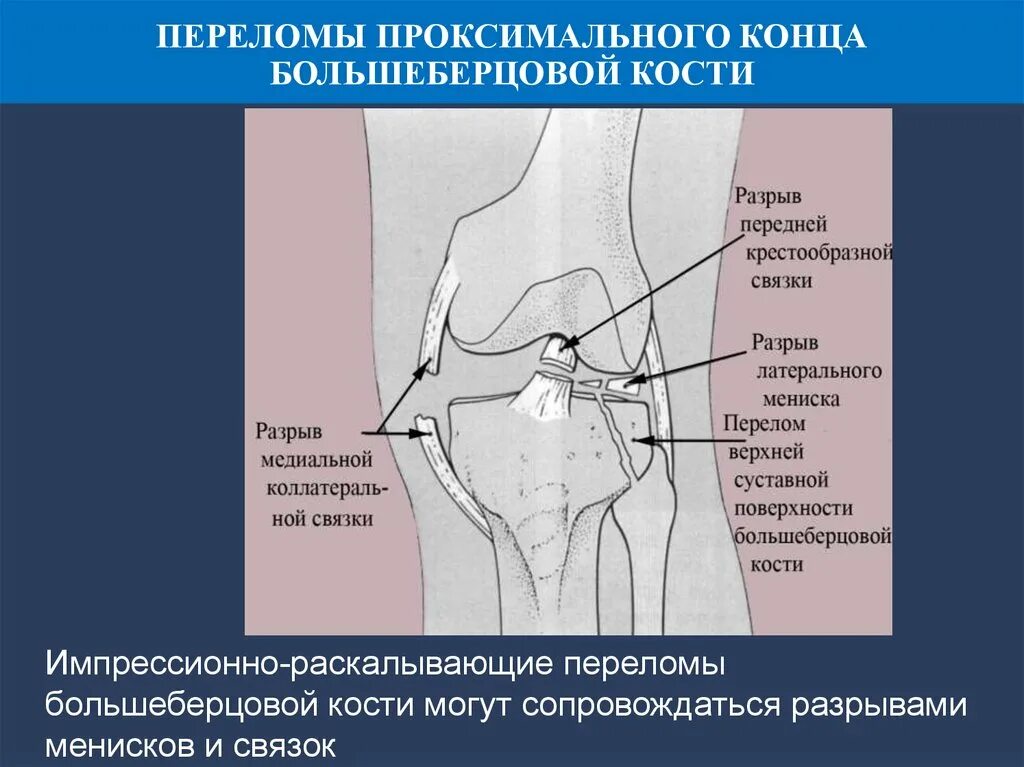 Повреждения мыщелка бедренной кости. Импрессионный перелом мыщелков большеберцовой кости. Импрессионный перелом большеберцовой кости коленного сустава. Перелом возвышения мыщелка большеберцовой кости. Перелом наружного мыщелка большеберцовой кости рентген.