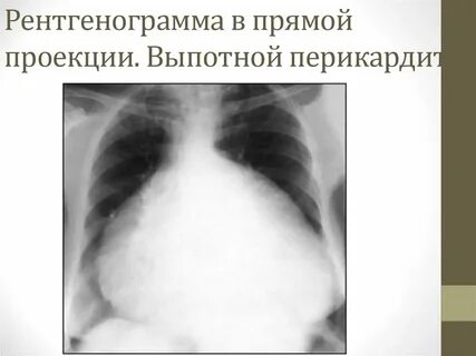 Панцирное сердце