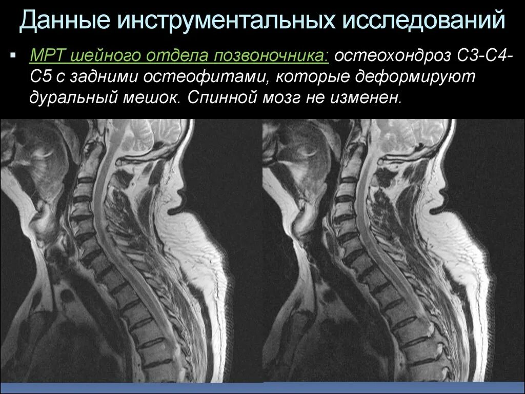 Мрт шейного отдела позвоночника и спинного мозга. Деформация дуральный мешок позвоночника. Дуральный мешок позвоночника шейного отдела. Мрт шейного отдела позвоночника по времени