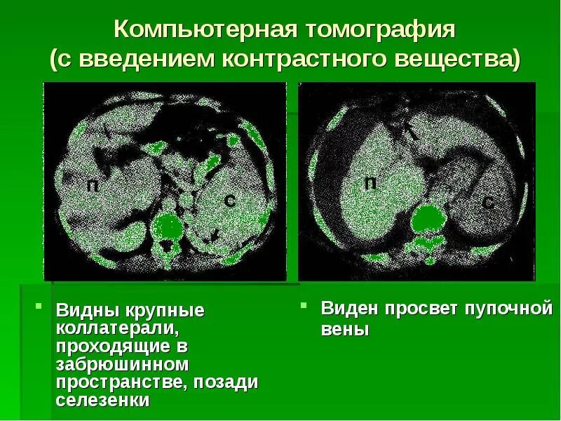 Какие анализы для кт с контрастом. Кт с введением контрастного вещества. Контрастные вещества для кт. Введение контрастного вещества при кт.