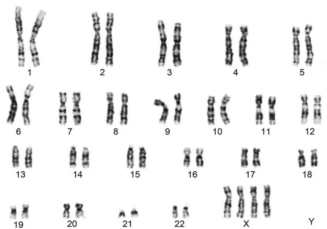 Вторая х хромосома. Трисомия 22 хромосомы кариотип. Тетрасомия х кариотип. Синдром Шерешевского Тернера кариотип. Трисомия х кариотип хромосоме кариотип.