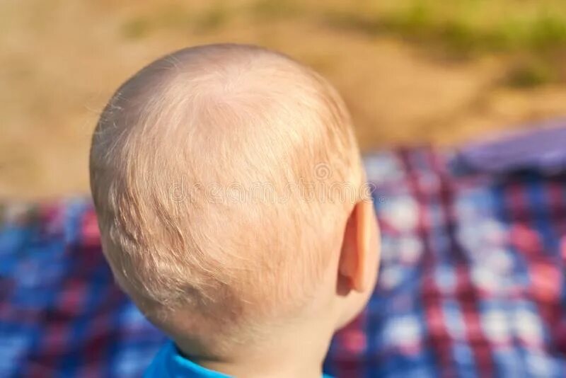 Пятнышки на затылке у младенца. Затылок мальчика. Облысение затылка у детей.