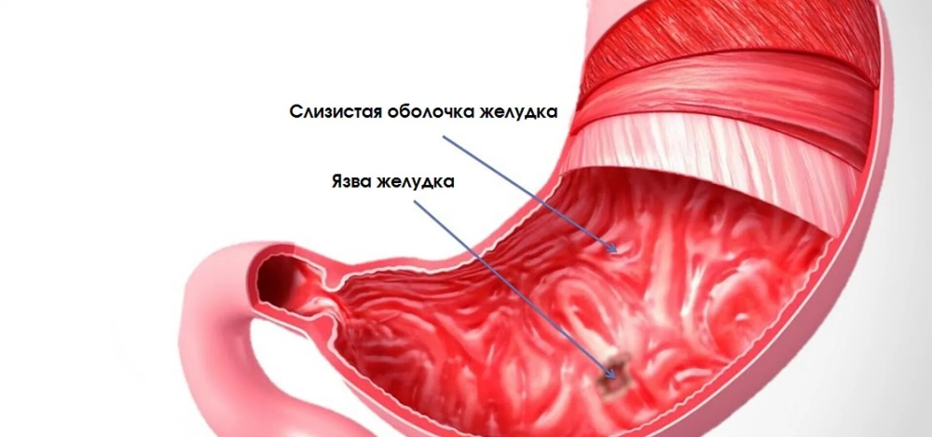 Язва желудка и 12 перстной кишки. Язва слизистой оболочки желудка. Изъязвление слизистой оболочки желудка. Слизистая оболочка 12 кишки