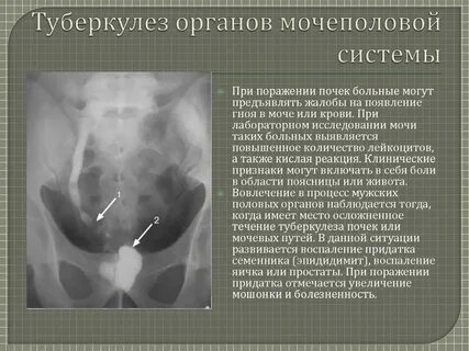 Почек предстательной железы