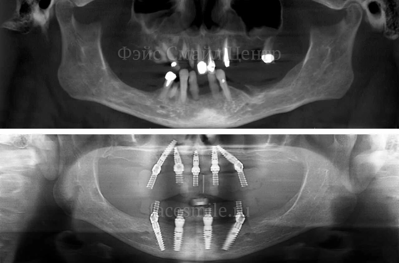 Кт нижней челюсти цена в ульяновске. Снимок челюсти с имплантами. Импоаниаты all on 4 ОПТГ. Снимок рентген all-on-4.