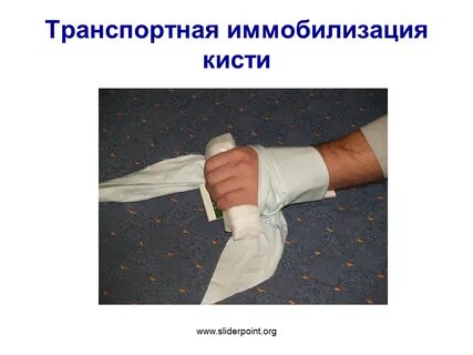 Наложение иммобилизирующей повязки