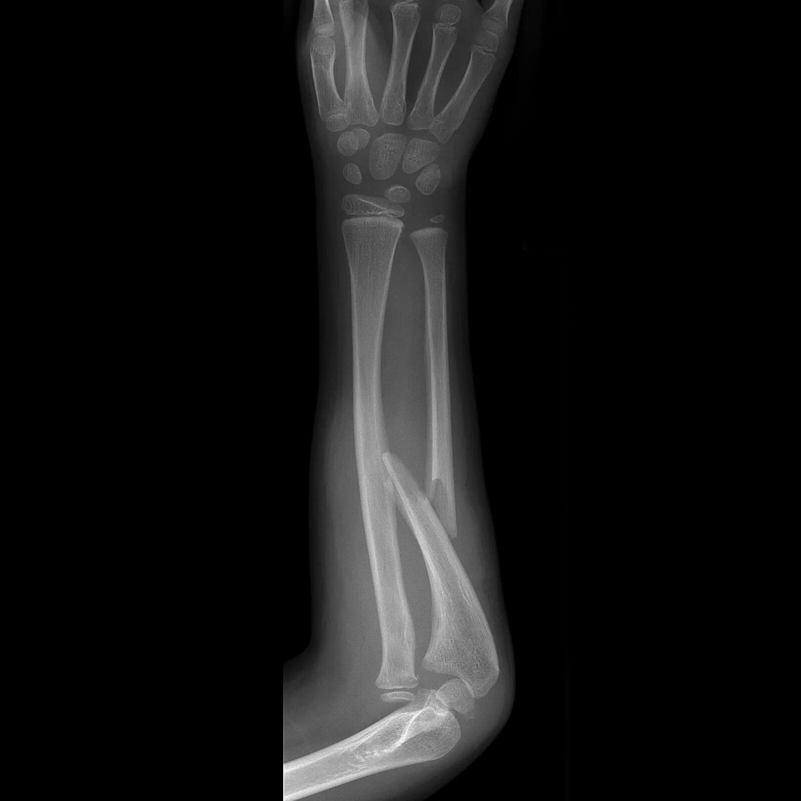 Fracture modeling