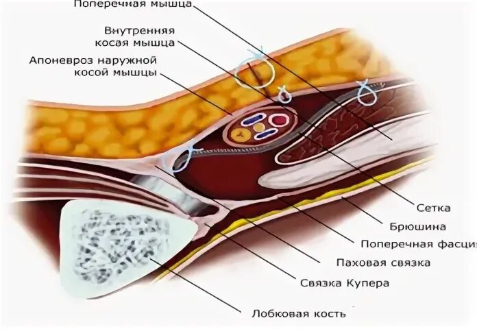 Герниопластика по Лихтенштейну. Грыжесечение паховой грыжи по Лихтенштейну. Герниопластика по Лихтенштейну схема. Сетчатый имплант герниопластика по Лихтенштейну. Лихтенштейн операция паховая