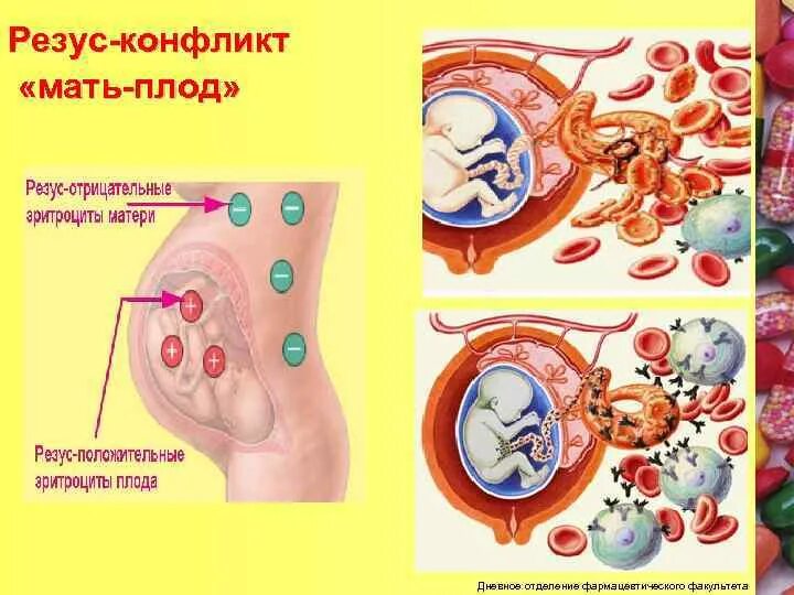 Резус несовместимость крови. Резус конфликт. Резус-конфликт при беременности. Резус конфликт беременность. Факторы риска резус конфликта.