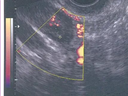 Киста желтого тела после овуляции