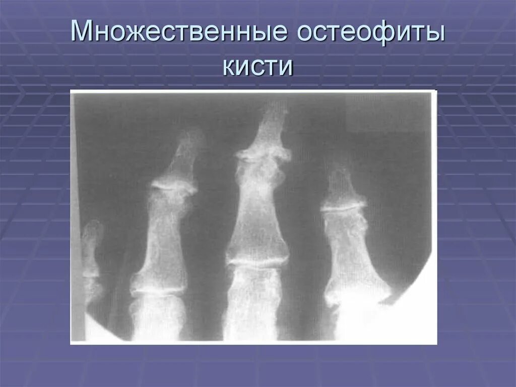 Остеофиты что это такое и как лечить. Остеофиты пястно фаланговых суставов. Остеоартроз рентген остеофиты. Остеофиты на рентгенограмме кисти. Остеофиты на суставе кисти.