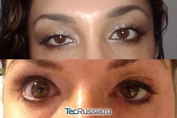 Птоз бровей после ботокса. Миогенный птоз верхнего века. Убрать птоз ботоксом. Убрать птоз ботоксом. Убрать птоз ботоксом.