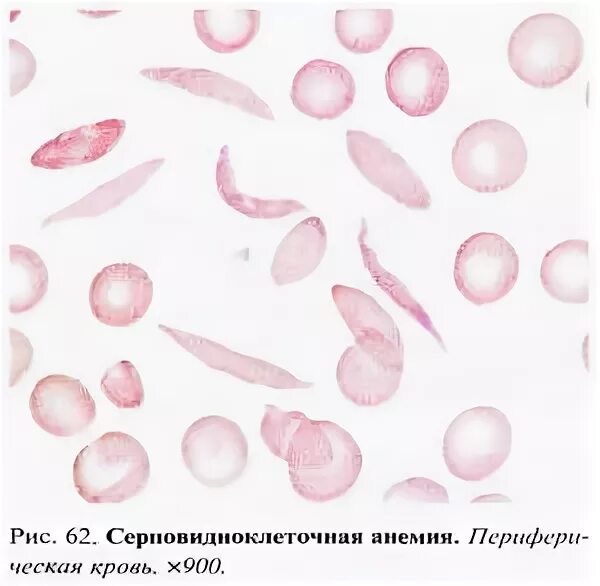 Серповидноклеточная анемия под микроскопом Sickle cell anaemia