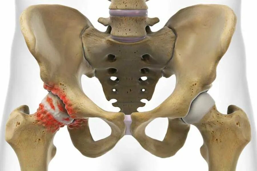 Коксалгия тазобедренного сустава. Протрузионный коксартроз. Коксартроза тазобедренного сустава. Медицина суставы тазобедренный